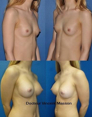 best breast surgery breast augmentation plastic surgery paris vincent masson